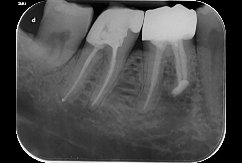 Wurzelspitzenresektion und Wurzelkanalaufbereitung: Zahnarztpraxis Dr. Recoder, Baar